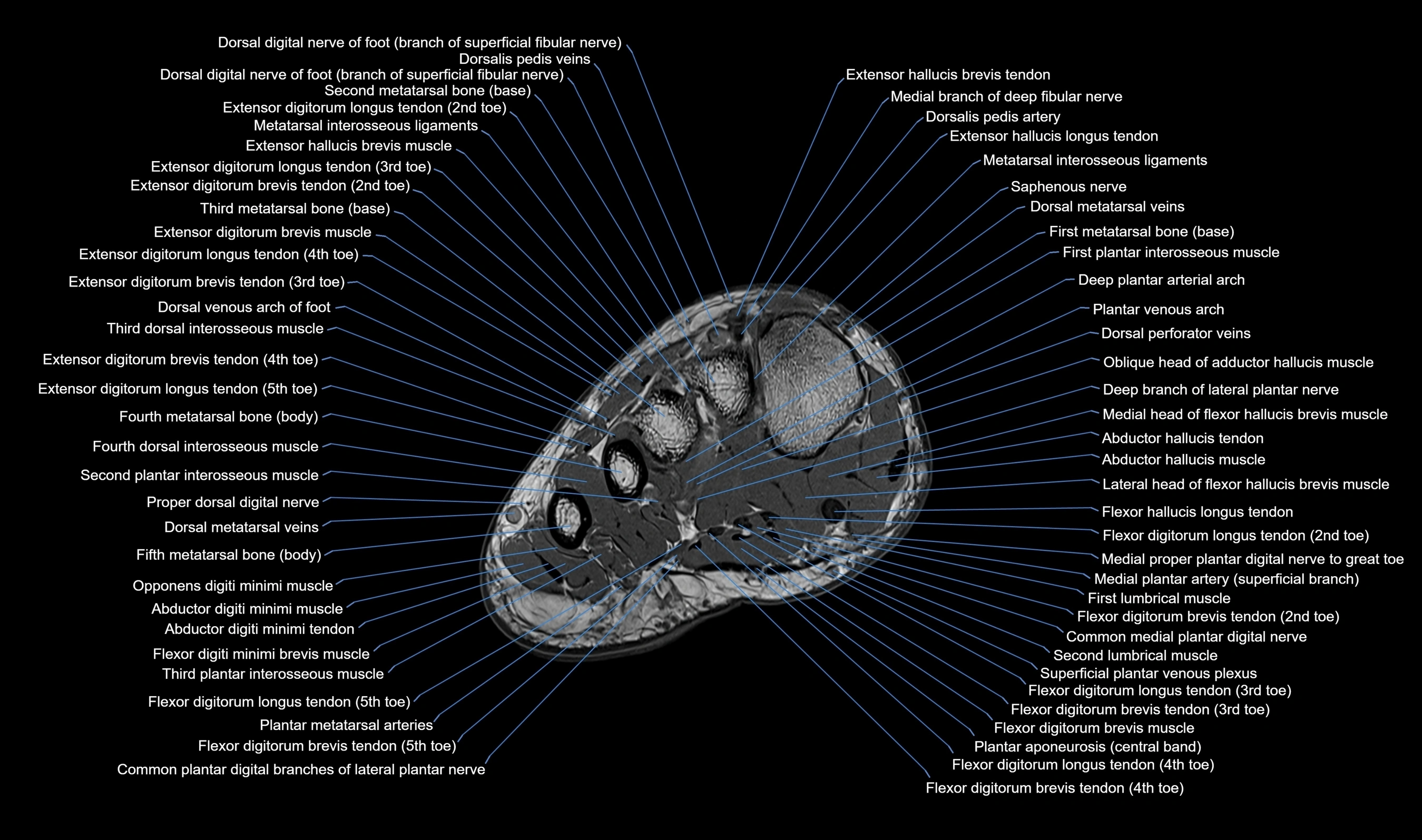 MRI mid foot axial cross sectional anatomy 3T  radiology  image-img-00001-00010.webp
